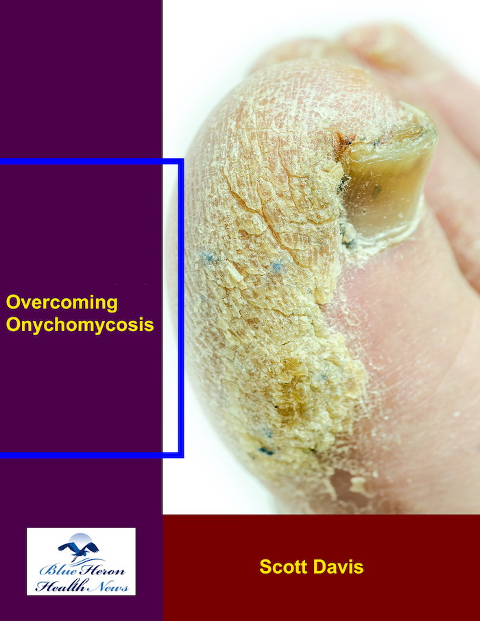Overcoming Onychomycosis